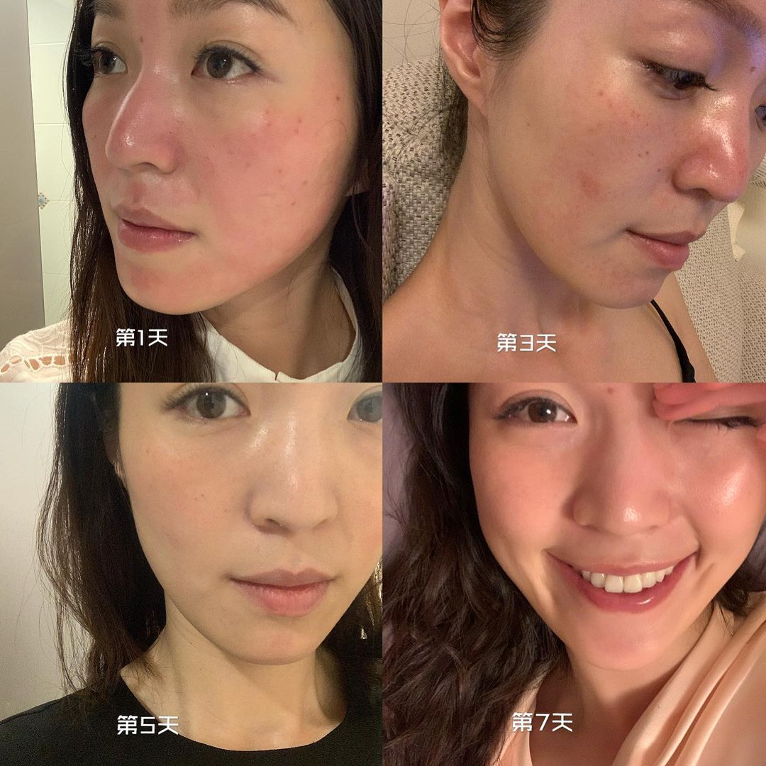【皮秒雷射】星和診所-台南市-女生保養無上限你們都怎麼解決呢？_Alicewheretogo | 愛麗絲去哪兒